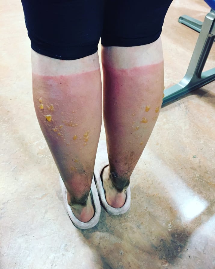 Woman's Horrifying Photos Are A Sunscreen Reminder ATTN